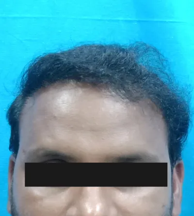 Activated Follicular Transplant Result After in VCare